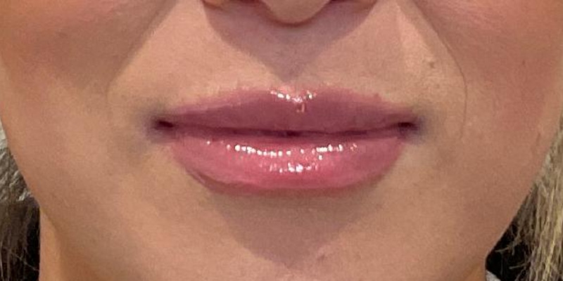 Lip Fillers Before & After Image