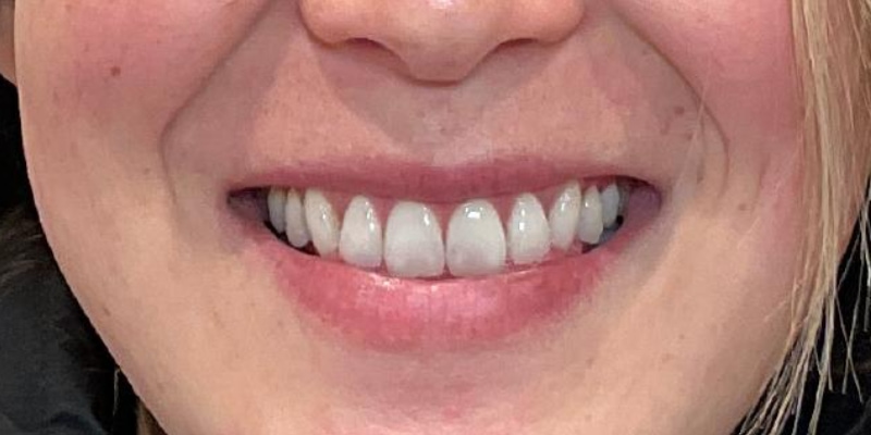 Lip Fillers Before & After Image