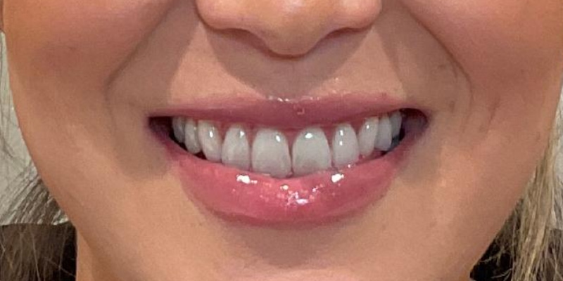 Lip Fillers Before & After Image