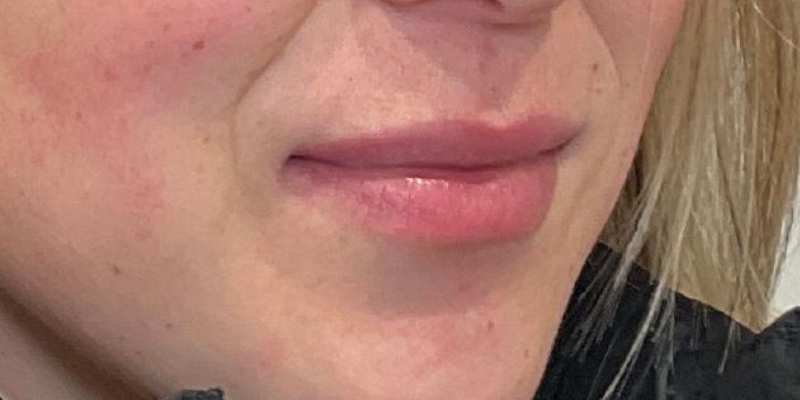 lip fillers Before & After Image