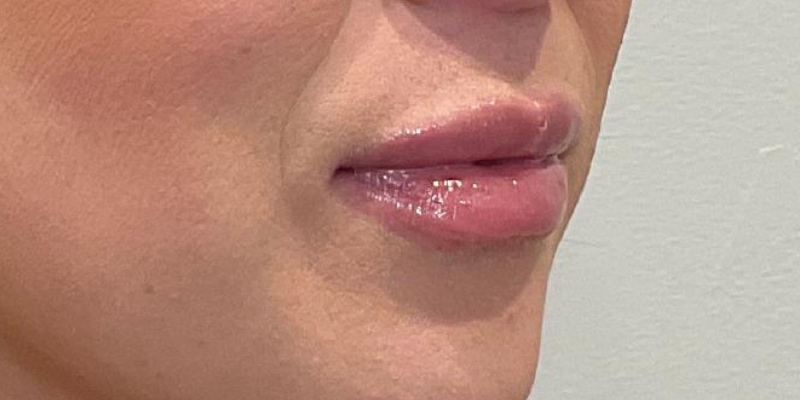 lip fillers Before & After Image