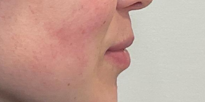 Lip Fillers Before & After Image