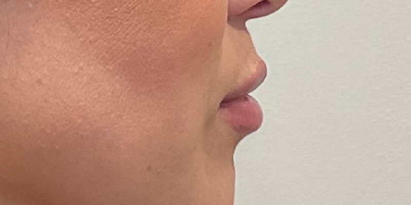 Lip Fillers Before & After Image