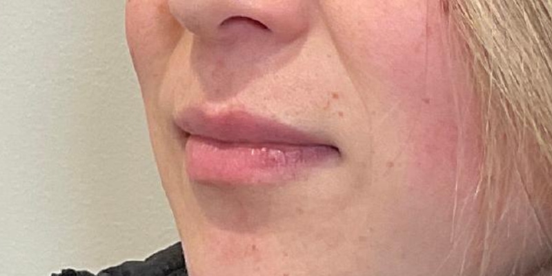 Lip Fillers Before & After Image