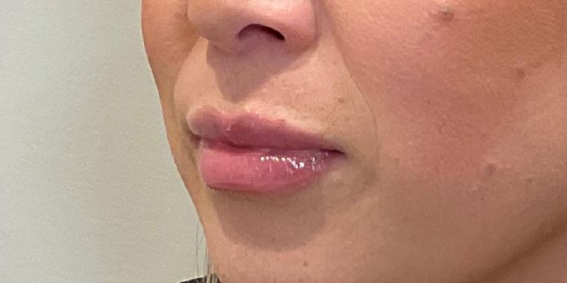 Lip Fillers Before & After Image