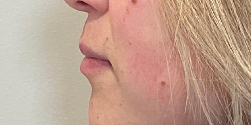 Lip Fillers Before & After Image
