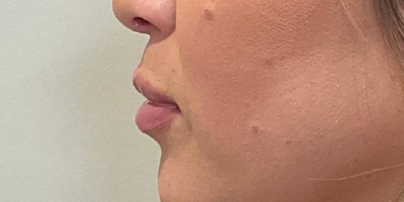 Lip Fillers Before & After Image