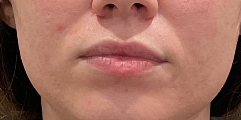 Lip Fillers Before & After Image