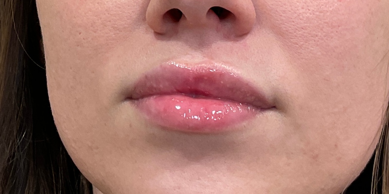 Lip Fillers Before & After Image