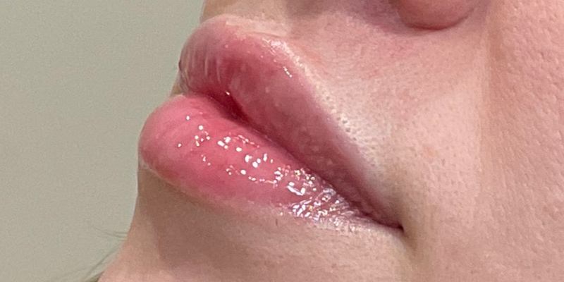 Lip Fillers Before & After Image