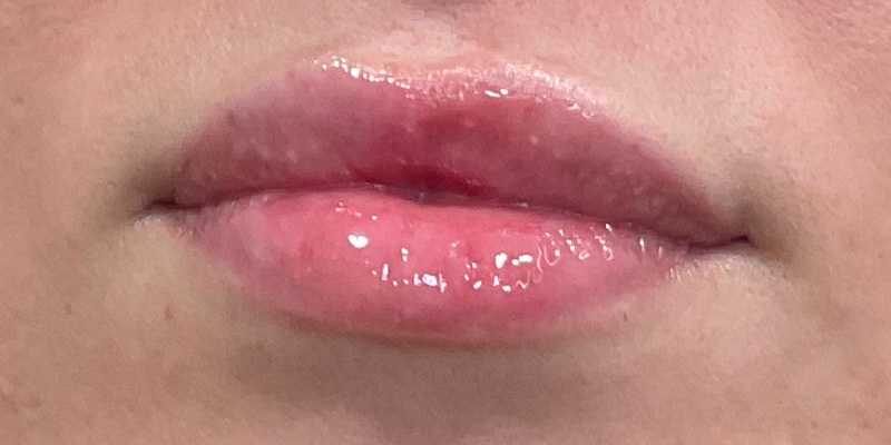 Lip Fillers Before & After Image