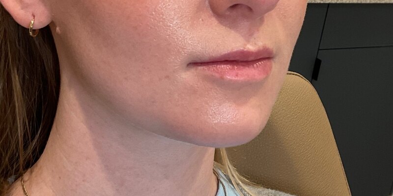 Lip Fillers Before & After Image