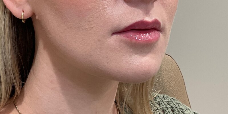 Lip Fillers Before & After Image