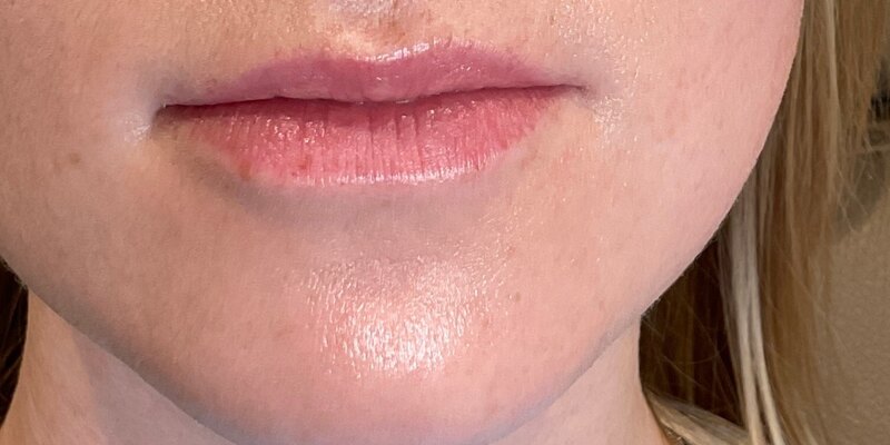 Lip Fillers Before & After Image