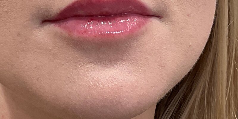 Lip Fillers Before & After Image