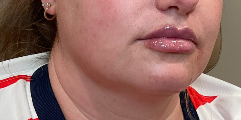 Lip Fillers Before & After Image