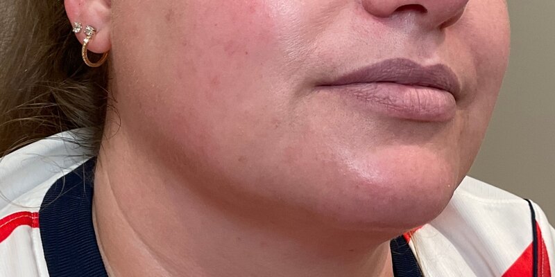 Lip Fillers Before & After Image