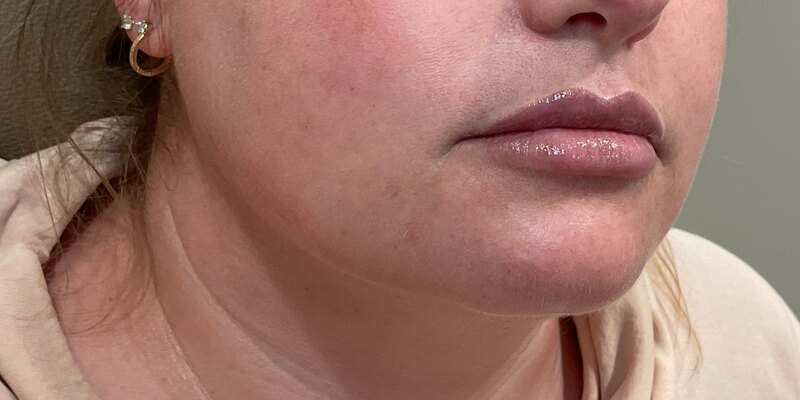 Lip Fillers Before & After Image