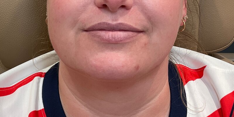 Lip Fillers Before & After Image