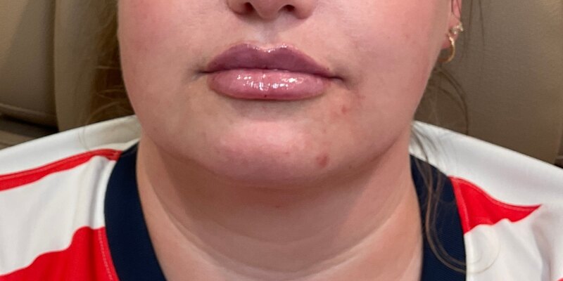 Lip Fillers Before & After Image