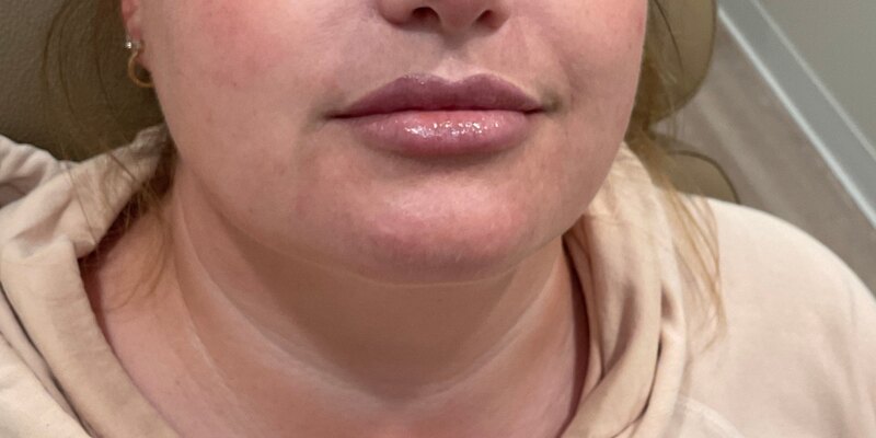 Lip Fillers Before & After Image