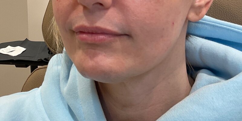 Lip Fillers Before & After Image