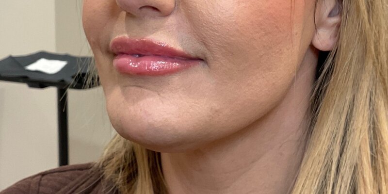 Lip Fillers Before & After Image