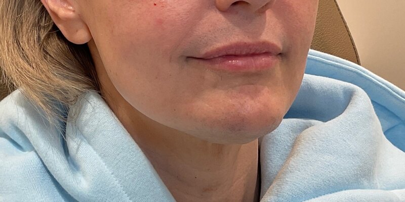 Lip Fillers Before & After Image