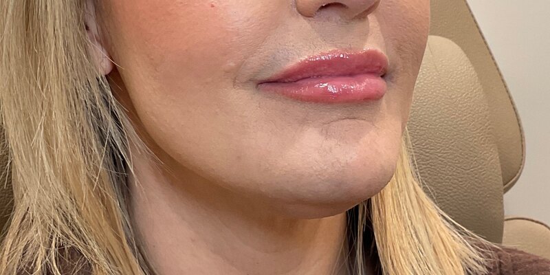 Lip Fillers Before & After Image
