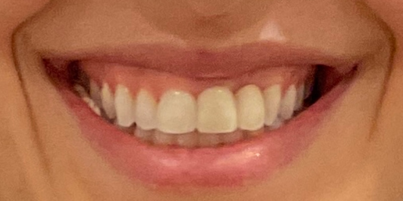 Lip Flip Before & After Image