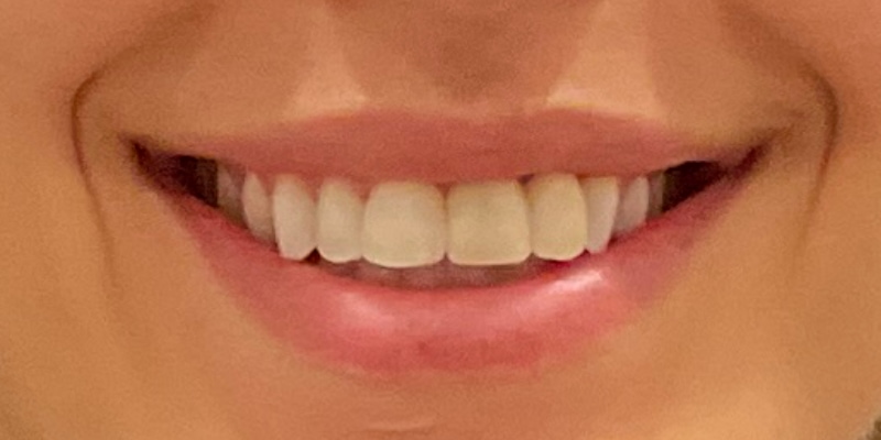 Lip Flip Before & After Image