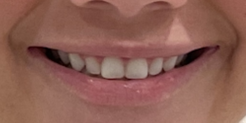 Lip Flip Before & After Image