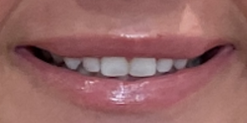 Lip Flip Before & After Image