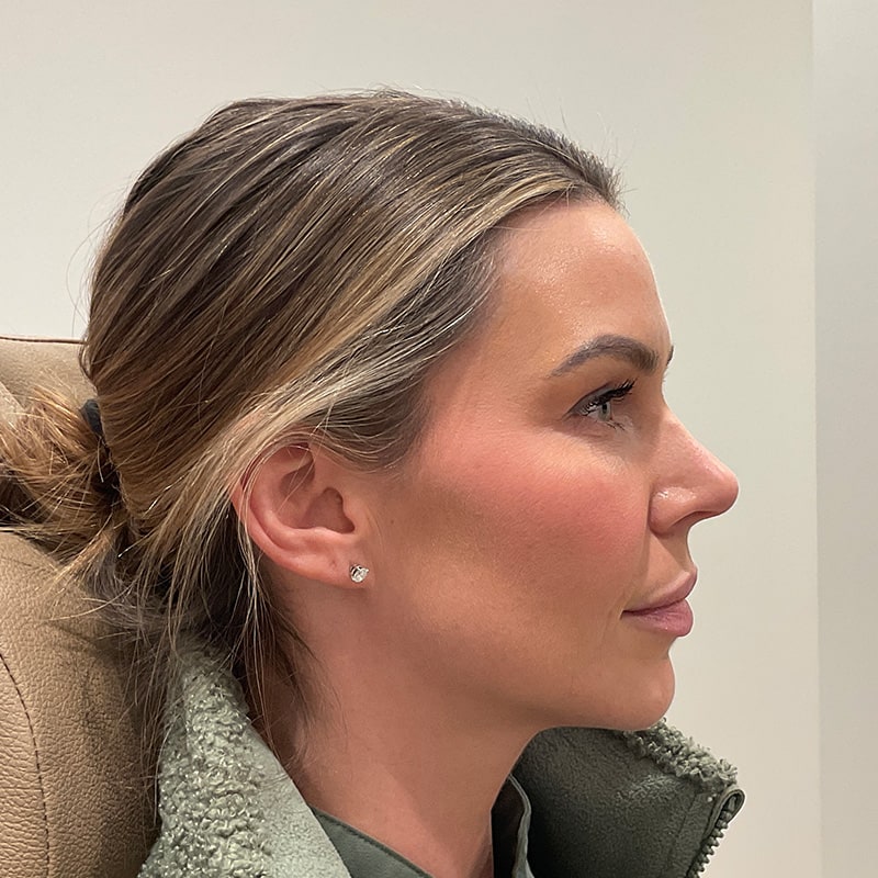 Radiesse Before & After Image