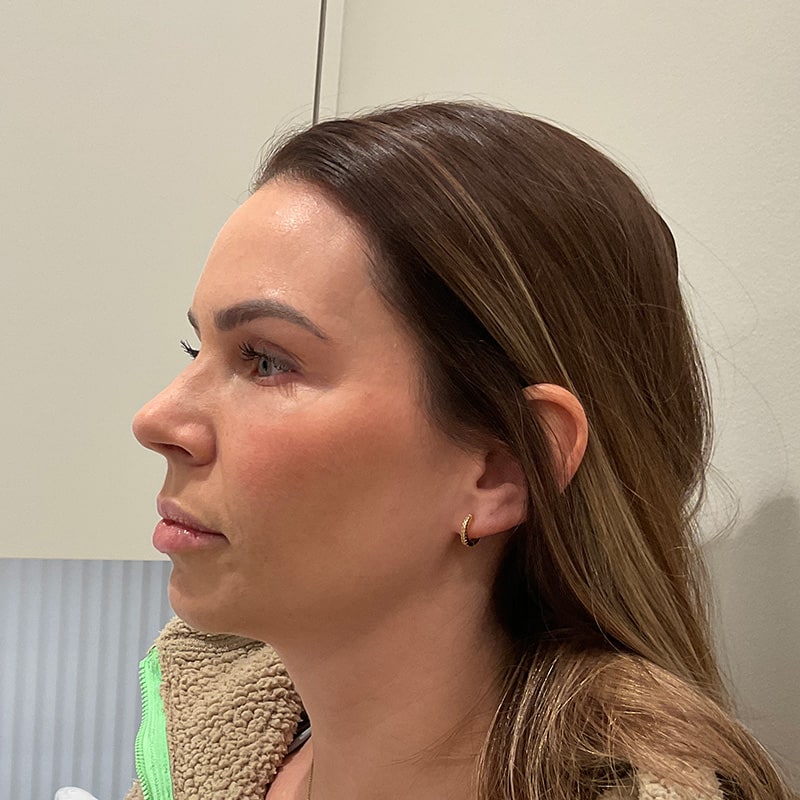 Radiesse Before & After Image