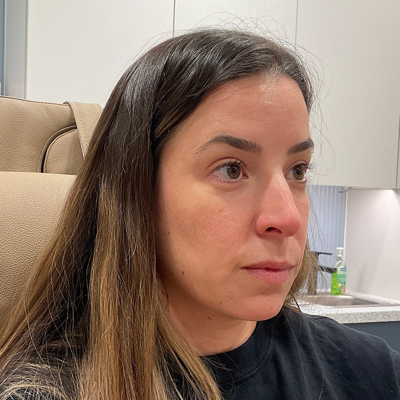 Radiesse Before & After Image