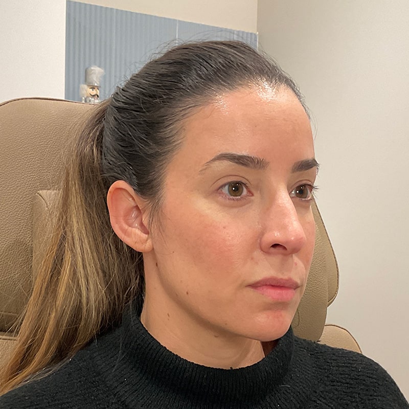 Radiesse Before & After Image