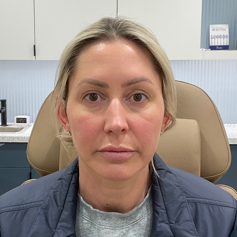 Radiesse Before & After Image