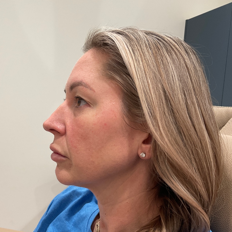Radiesse Before & After Image