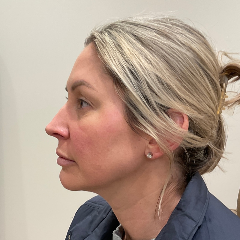 Radiesse Before & After Image