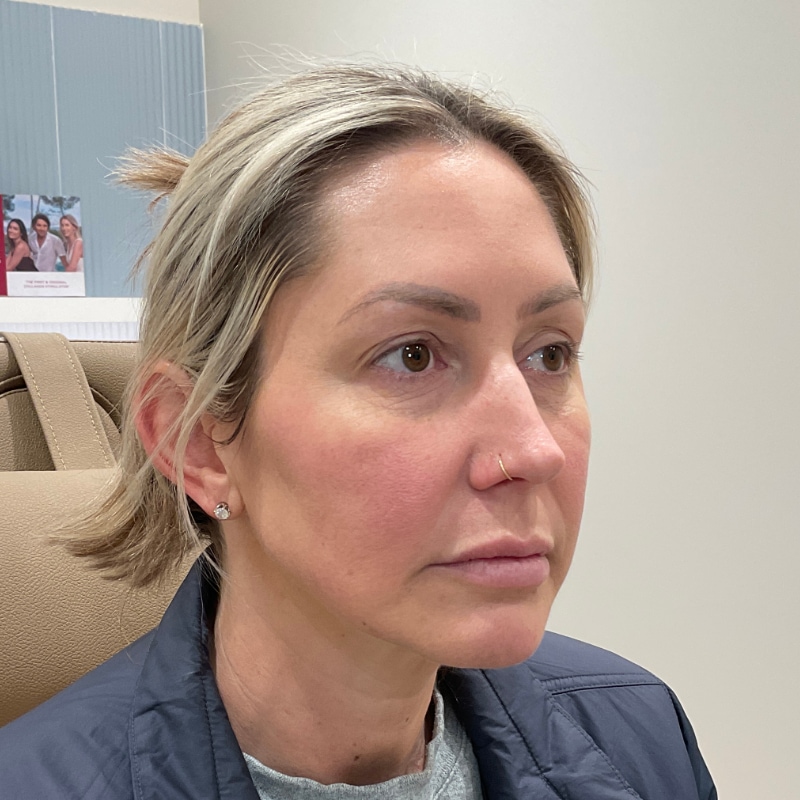Radiesse Before & After Image