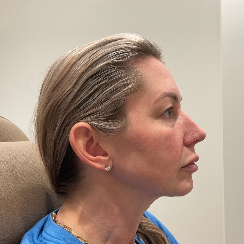 Radiesse Before & After Image