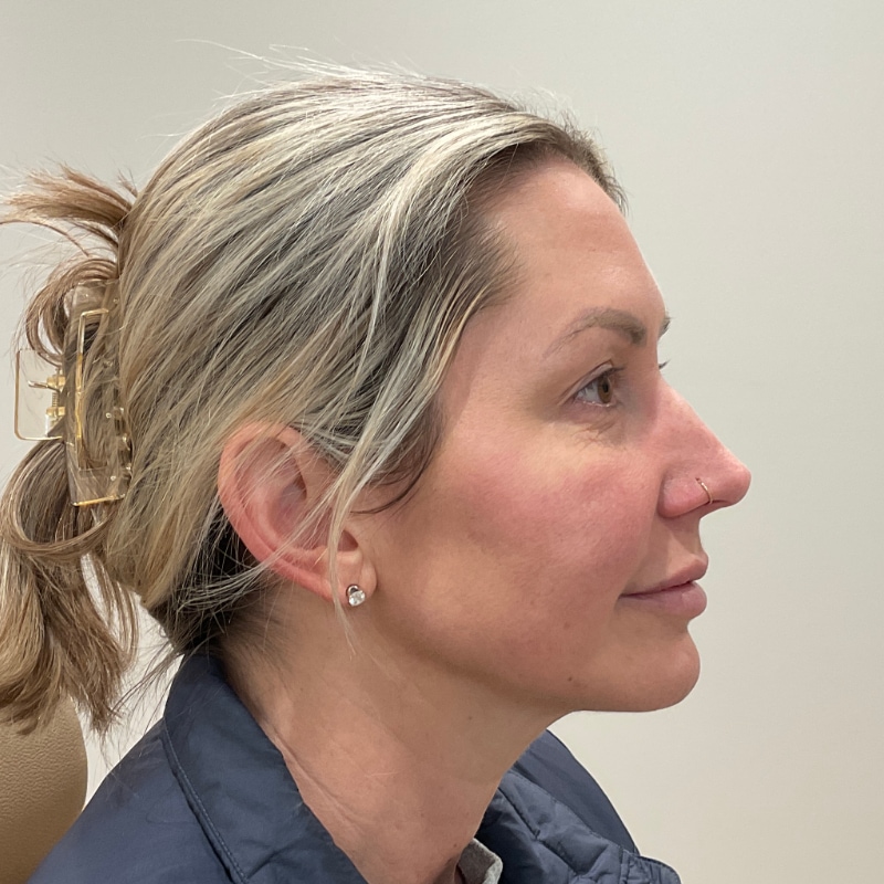 Radiesse Before & After Image
