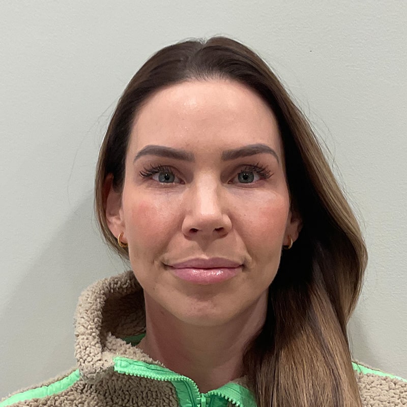 Sculptra Before & After Image