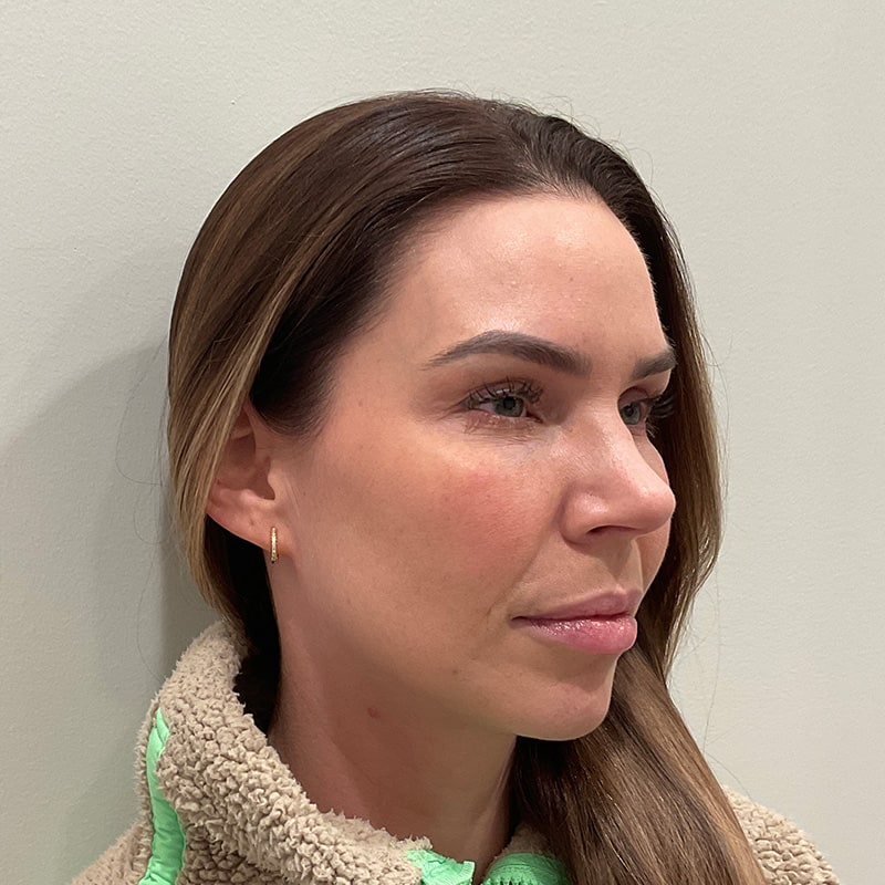 Sculptra Before & After Image