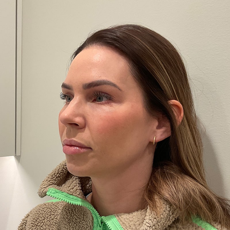 Sculptra Before & After Image