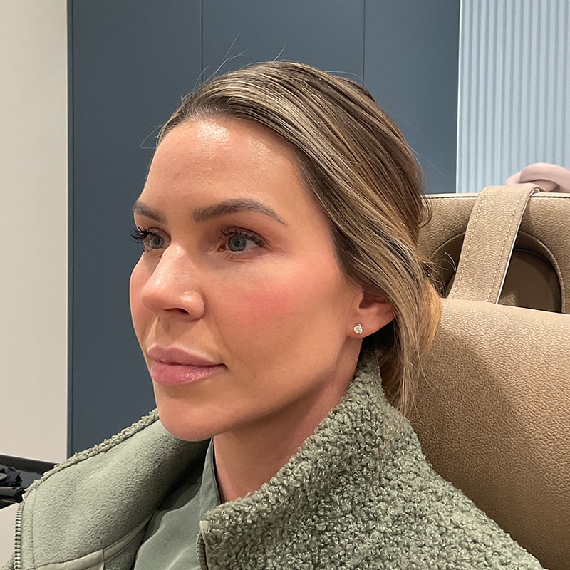 Sculptra Before & After Image