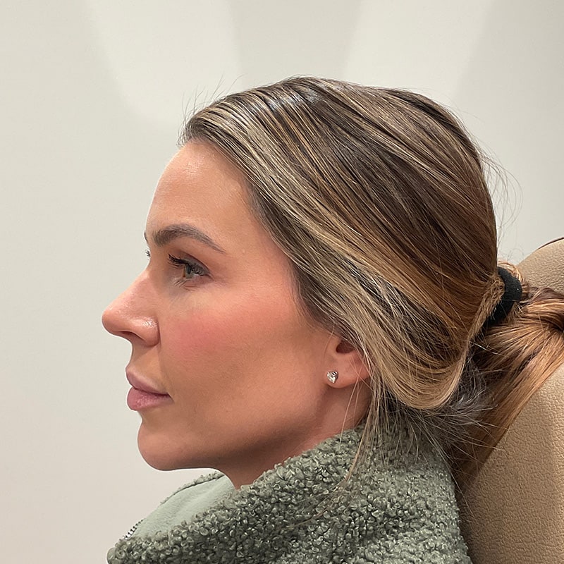 Sculptra Before & After Image