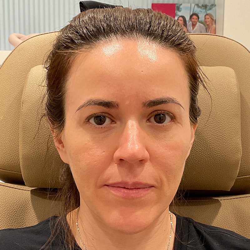 Sculptra Before & After Image