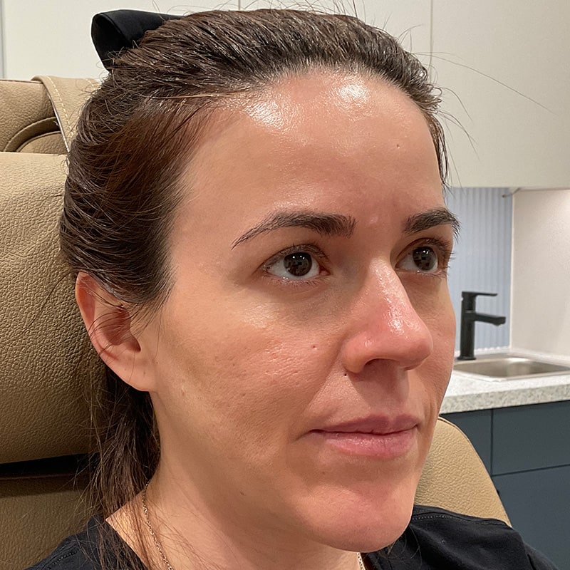 Sculptra Before & After Image